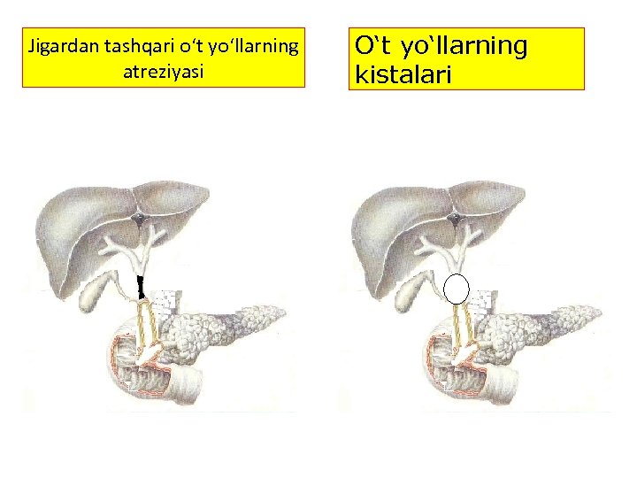 Jigardan tashqari o‘t yo‘llarning atreziyasi O‘t yo‘llarning kistalari 