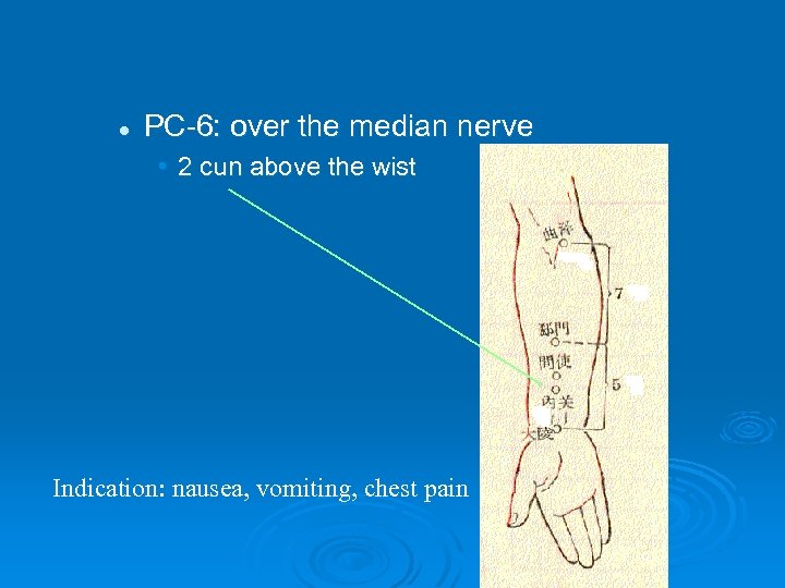 l PC-6: over the median nerve • 2 cun above the wist Indication: nausea,