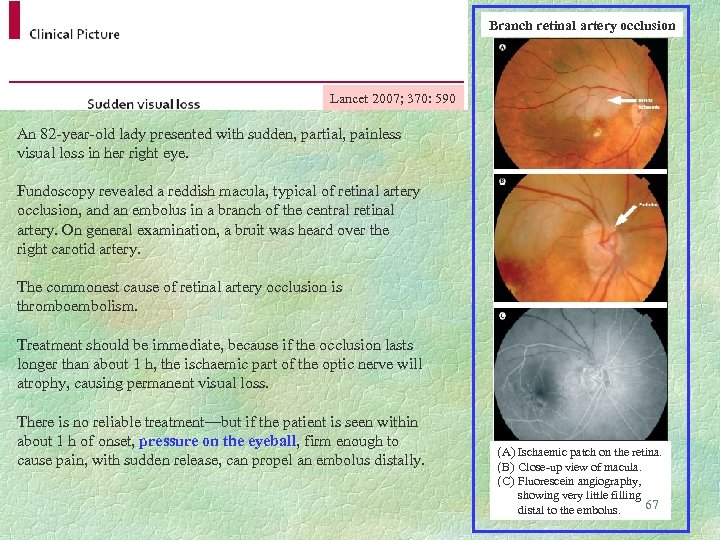 Branch retinal artery occlusion Lancet 2007; 370: 590 An 82 -year-old lady presented with