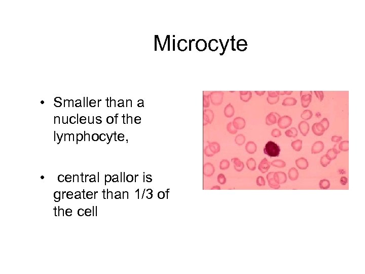 Microcyte • Smaller than a nucleus of the lymphocyte, • central pallor is greater