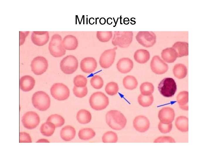 Microcytes 