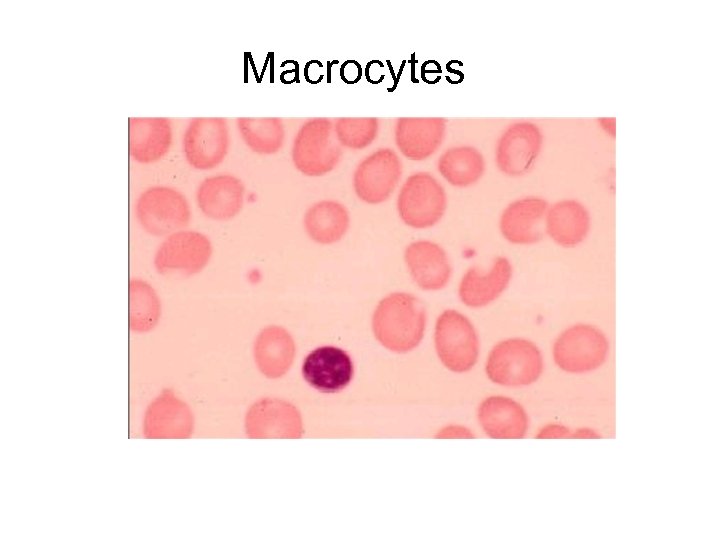 Macrocytes 