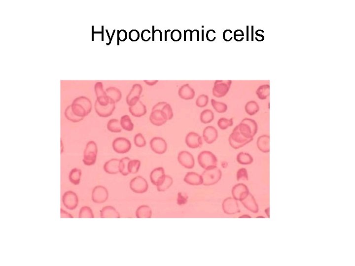 Hypochromic cells 