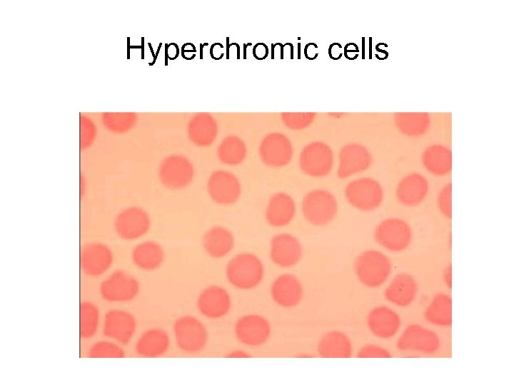 Hyperchromic cells 