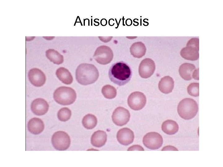 Anisocytosis 