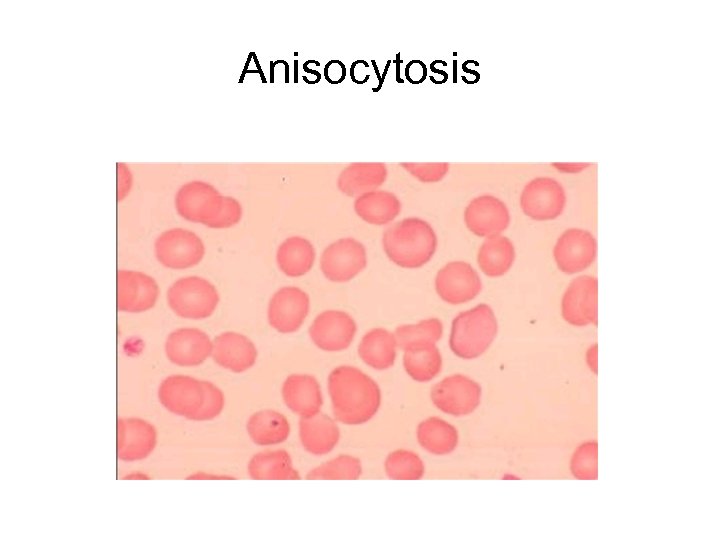 Anisocytosis 