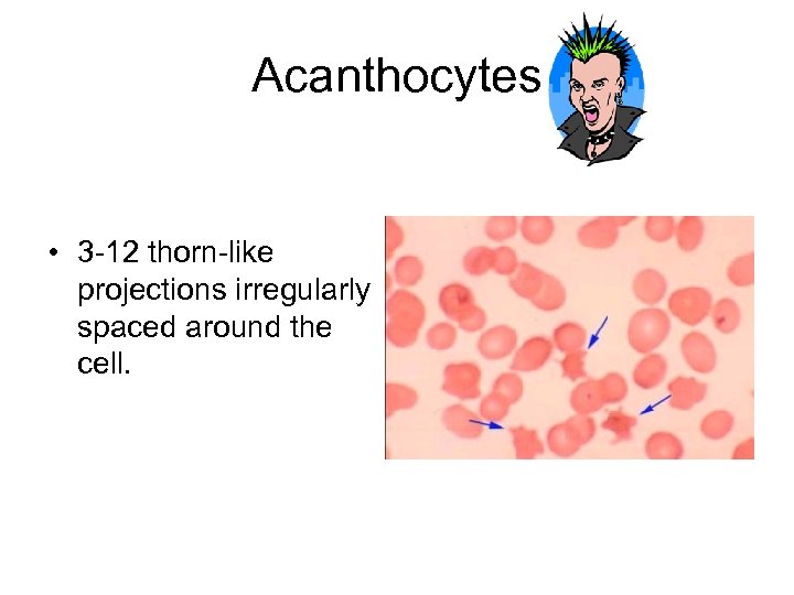 Acanthocytes • 3 -12 thorn-like projections irregularly spaced around the cell. 