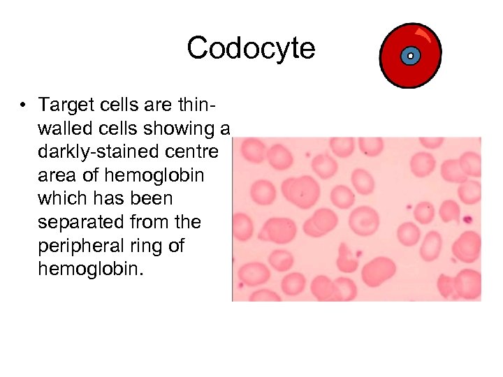 Codocyte • Target cells are thinwalled cells showing a darkly-stained centre area of hemoglobin