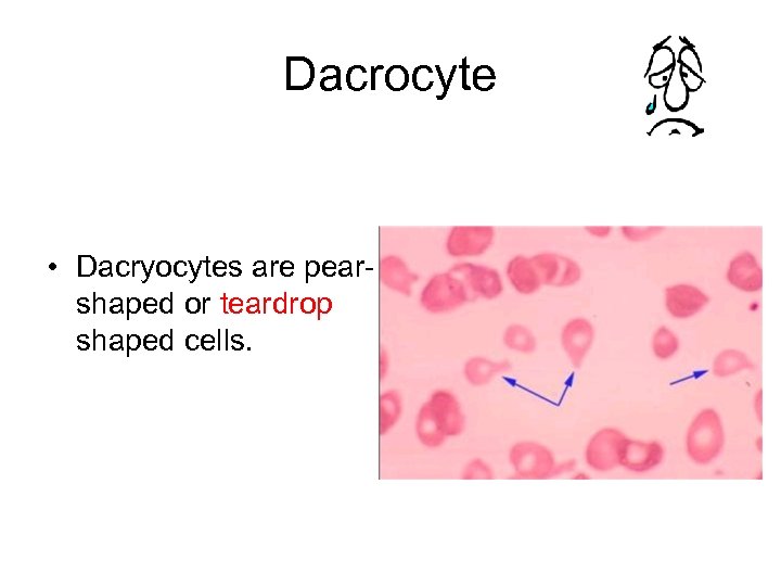 Dacrocyte • Dacryocytes are pearshaped or teardrop shaped cells. 