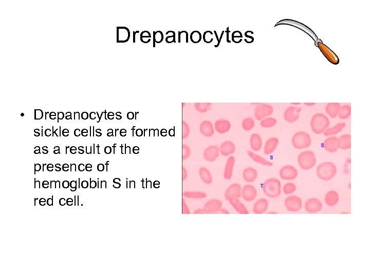 Drepanocytes • Drepanocytes or sickle cells are formed as a result of the presence