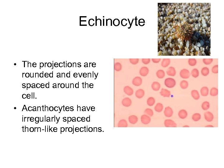 Echinocyte • The projections are rounded and evenly spaced around the cell. • Acanthocytes