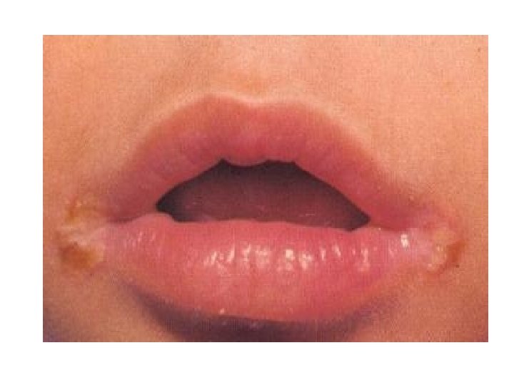 Гипертрофия губ фото