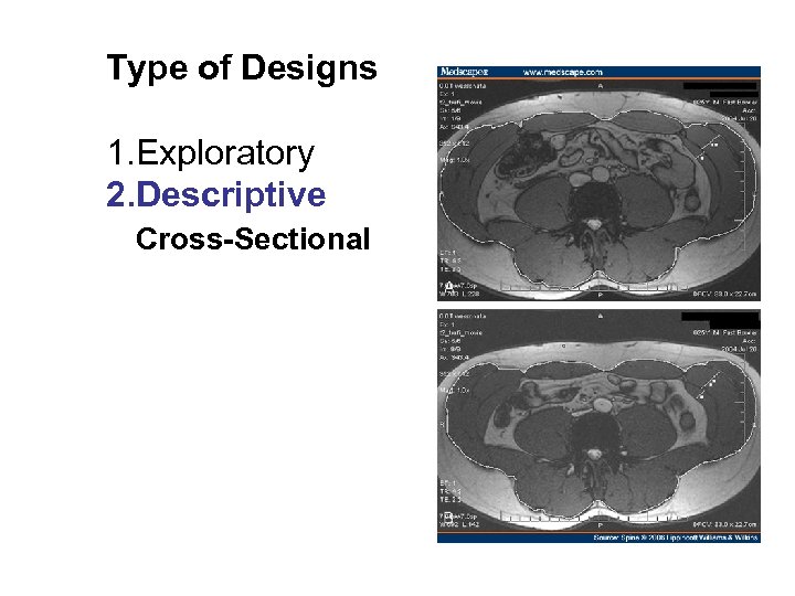 Type of Designs 1. Exploratory 2. Descriptive Cross-Sectional 