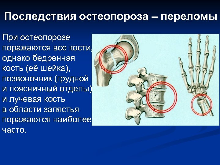 Последствия остеопороза – переломы При остеопорозе поражаются все кости, однако бедренная кость (её шейка),