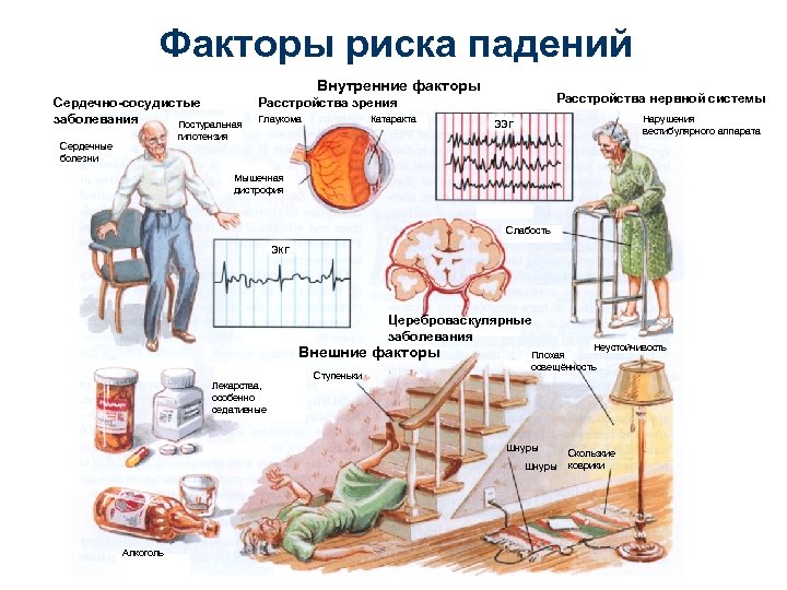 Факторы риска падений Внутренние факторы Сердечно-сосудистые заболевания Постуральная Расстройства нервной системы Расстройства зрения Глаукома