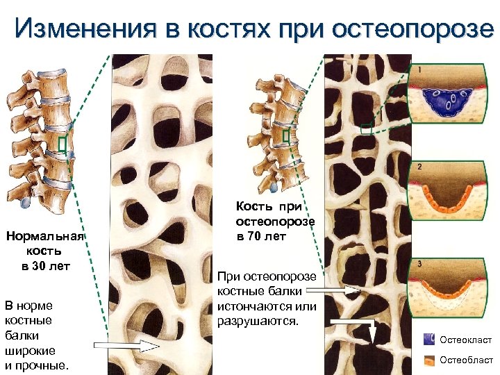 Изменения в костях при остеопорозе Нормальная кость в 30 лет В норме костные балки