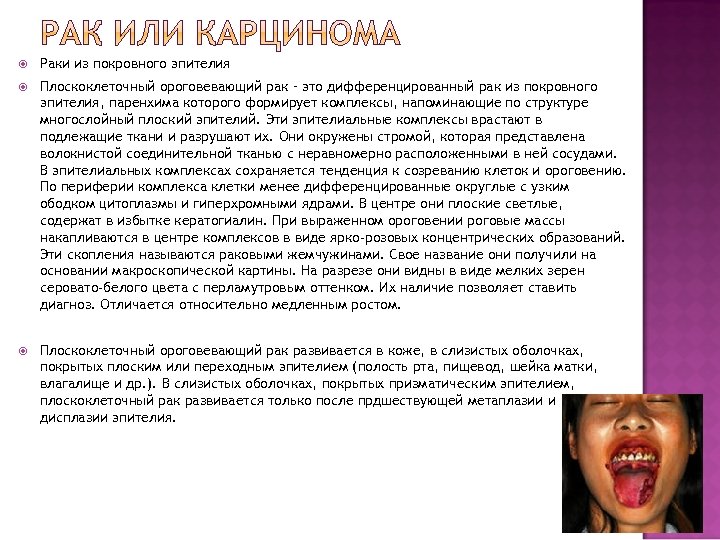  Раки из покровного эпителия Плоскоклеточный ороговевающий рак – это дифференцированный рак из покровного