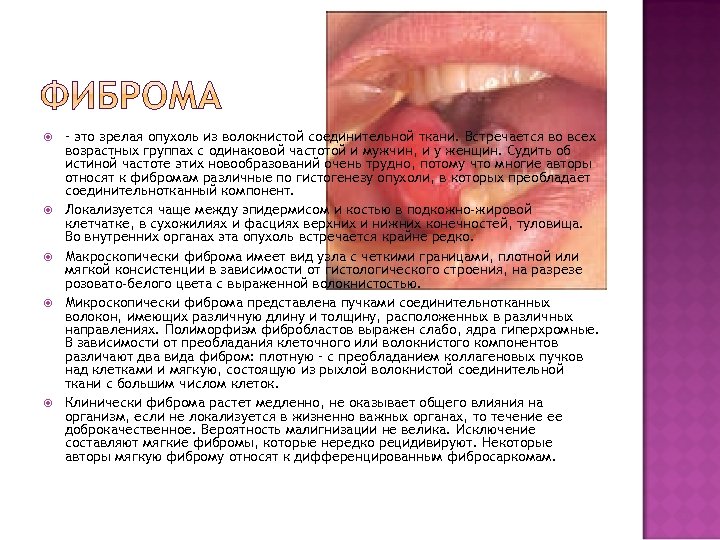  – это зрелая опухоль из волокнистой соединительной ткани. Встречается во всех возрастных группах