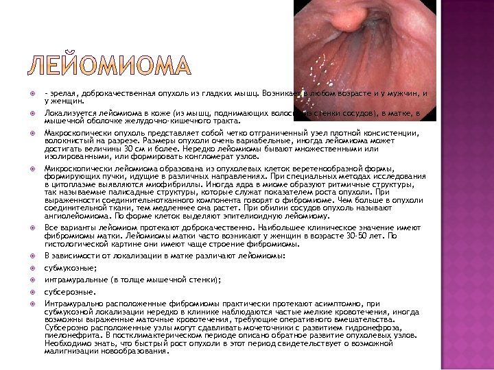  – зрелая, доброкачественная опухоль из гладких мышц. Возникает в любом возрасте и у