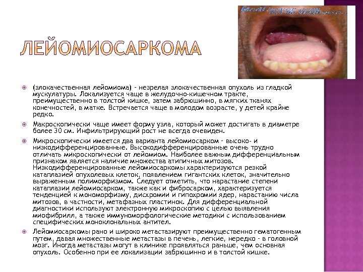  (злокачественная лейомиома) – незрелая злокачественная опухоль из гладкой мускулатуры. Локализуется чаще в желудочно-кишечном