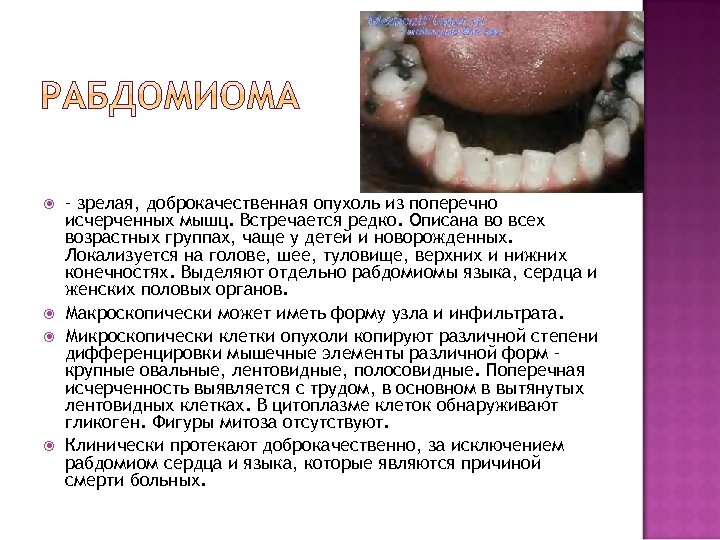  – зрелая, доброкачественная опухоль из поперечно исчерченных мышц. Встречается редко. Описана во всех