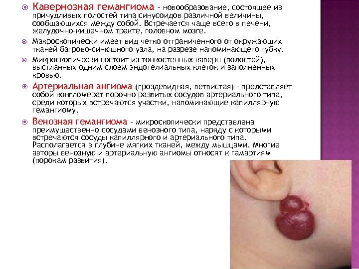 Кавернозная гемангиома – новообразование, состоящее из причудливых полостей типа синусоидов различной величины, сообщающихся между