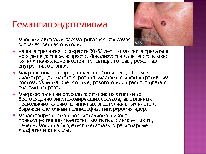 Гемангиоэндотелиома – многими авторами рассматривается как самая злокачественная опухоль. Чаще встречается в возрасте 30
