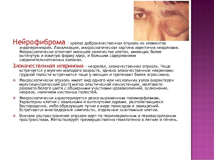 Нейрофиброма – зрелая доброкачественная опухоль из элементов эндопериневрия. Локализация, макроскопическая картина идентична невриноме. Микроскопически