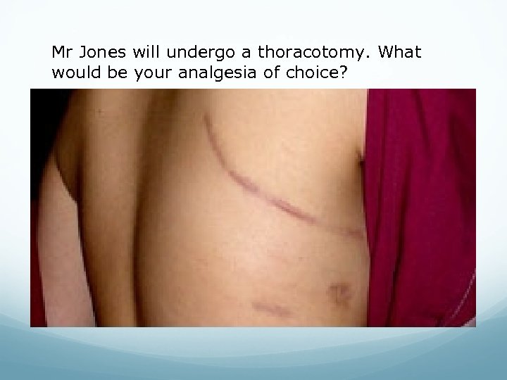 Mr Jones will undergo a thoracotomy. What would be your analgesia of choice? 