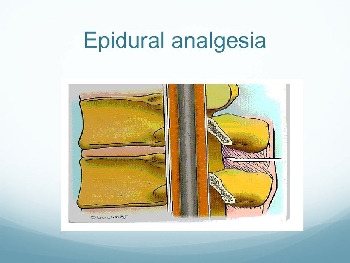 Epidural analgesia 