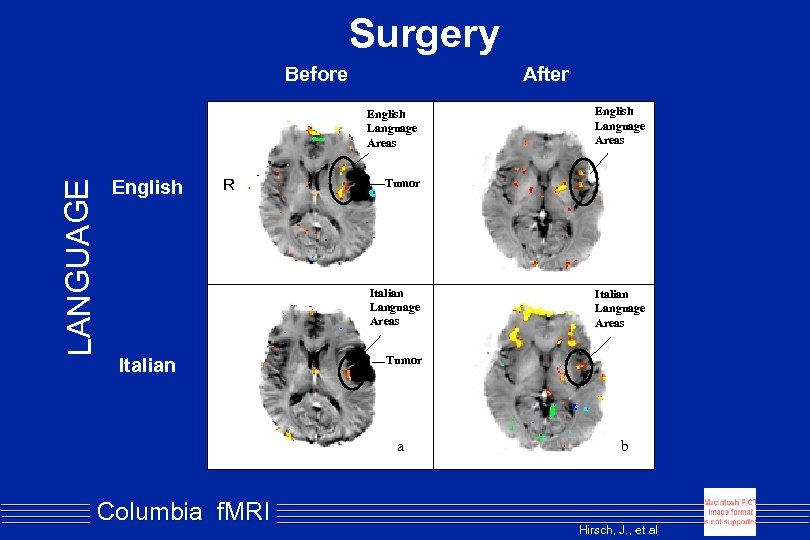 Surgery Before After LANGUAGE English Language Areas English R Tumor Italian Language Areas Tumor