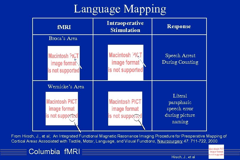 Language Mapping f. MRI Intraoperative Stimulation Response Broca’s Area Speech Arrest During Counting Wernicke’s