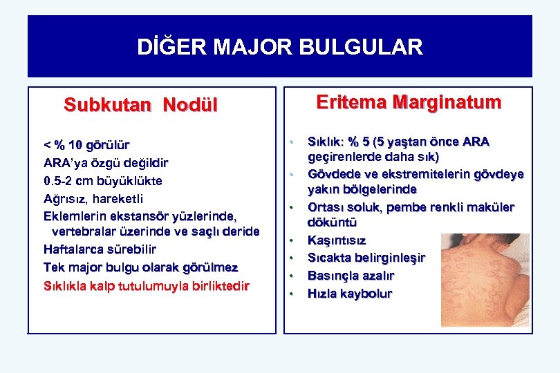 DİĞER MAJOR BULGULAR Eritema Marginatum Subkutan Nodül < % 10 görülür ARA’ya özgü değildir