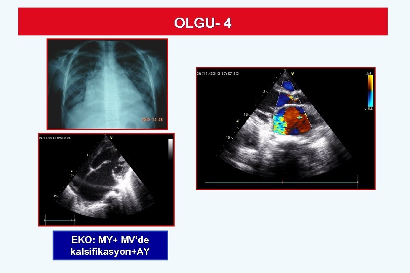 OLGU- 4 EKO: MY+ MV’de kalsifikasyon+AY 