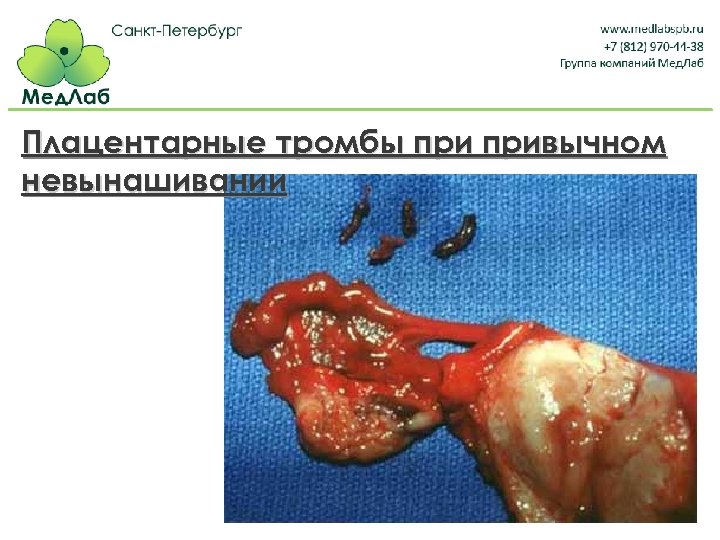 Плацентарные тромбы привычном невынашивании 
