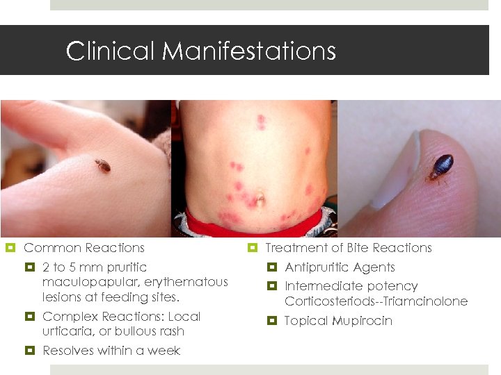 Clinical Manifestations Common Reactions 2 to 5 mm pruritic maculopapular, erythematous lesions at feeding