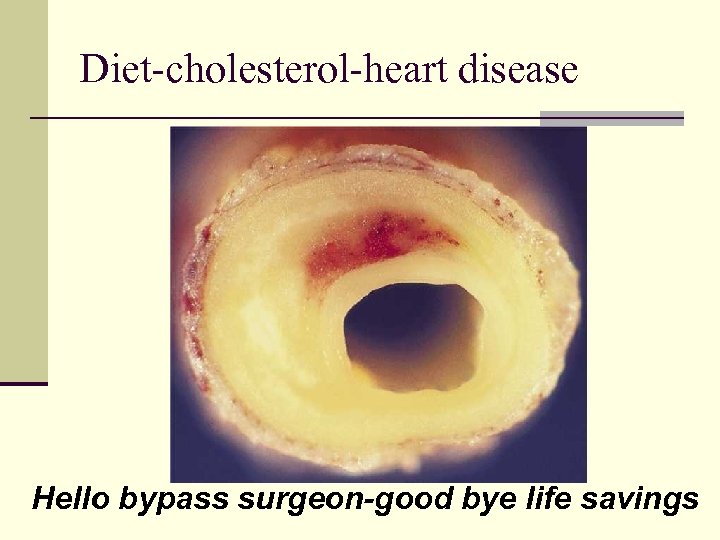 Diet-cholesterol-heart disease Hello bypass surgeon-good bye life savings 