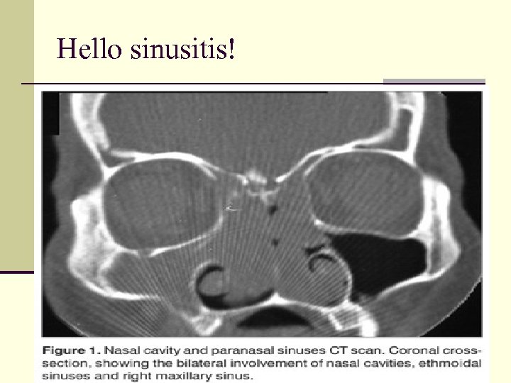 Hello sinusitis! 