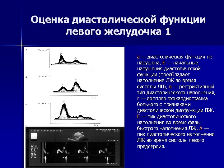 Оценка диастолической функции левого желудочка 1 а — диастолическая функция не нарушена, б —