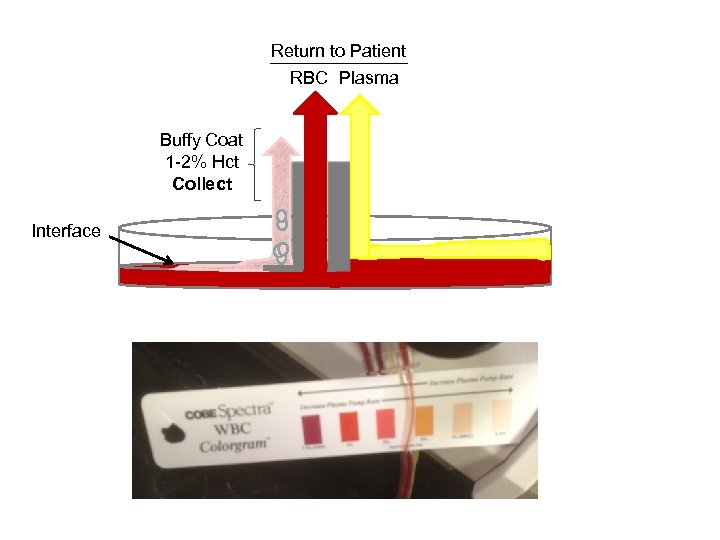 Return to Patient RBC Plasma Buffy Coat 1 -2% Hct Collect Interface 