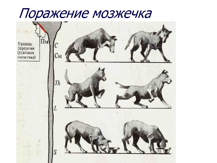 Поражение мозжечка 