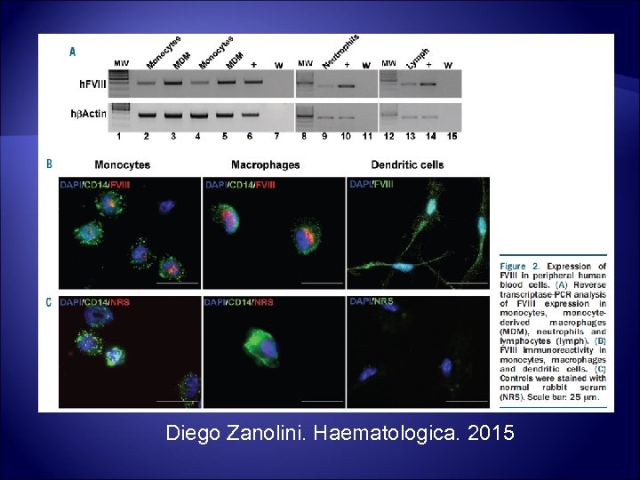 Diego Zanolini. Haematologica. 2015 