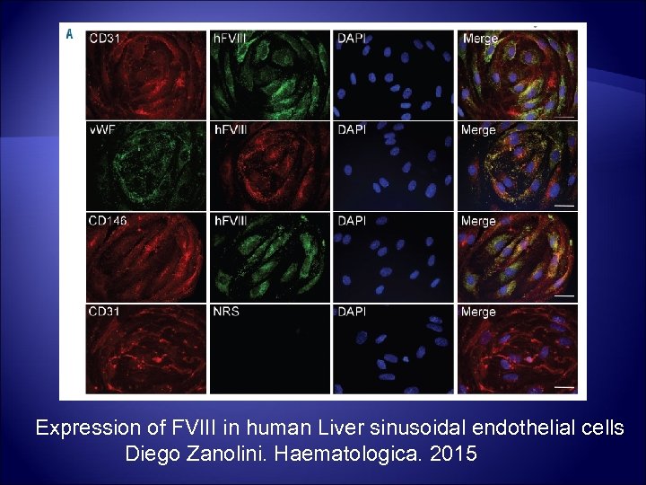 Expression of FVIII in human Liver sinusoidal endothelial cells Diego Zanolini. Haematologica. 2015 