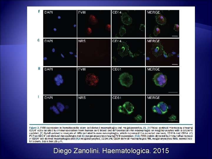 Diego Zanolini. Haematologica. 2015 