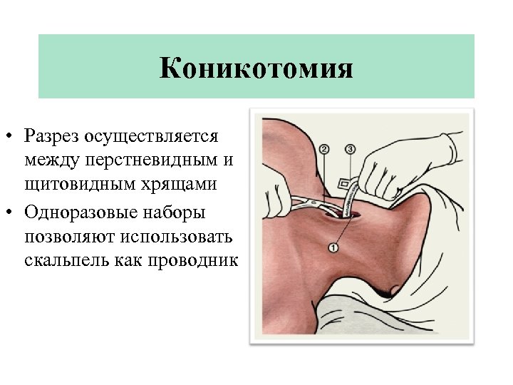 Разрез между. Пункционная коникотомия. Экстренная коникотомия. Коникотомия показания техника выполнения.