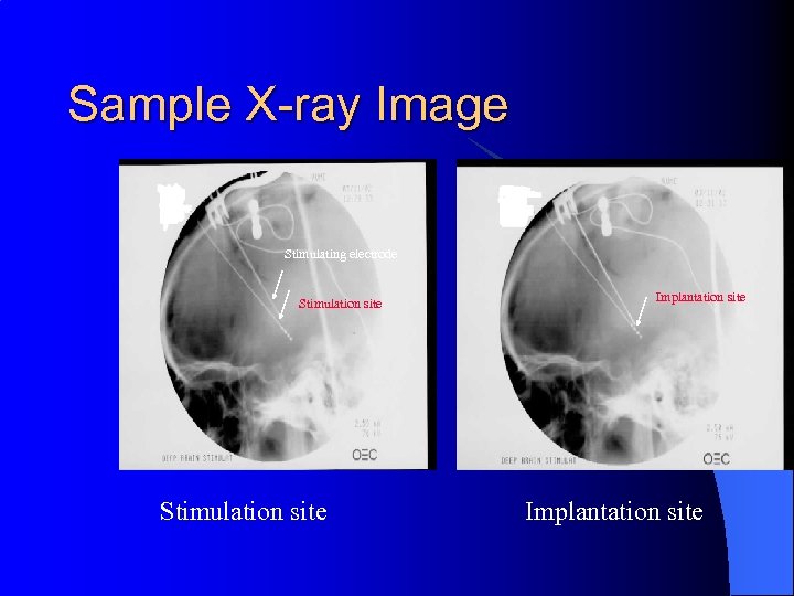 Sample X-ray Image Stimulating electrode Stimulation site Implantation site 