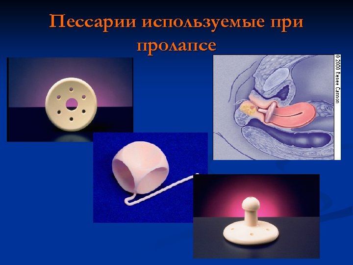 Пессарии используемые при пролапсе 
