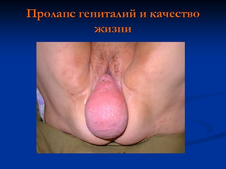 Пролапс гениталий и качество жизни 