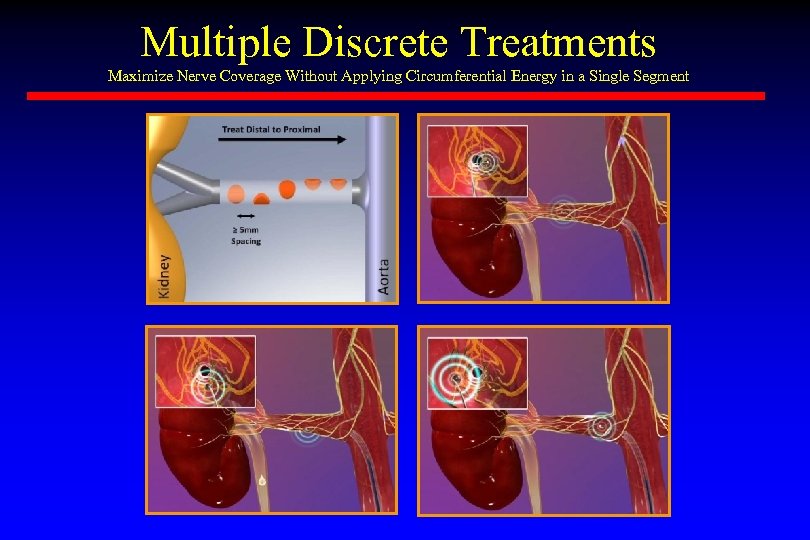 Multiple Discrete Treatments Maximize Nerve Coverage Without Applying Circumferential Energy in a Single Segment