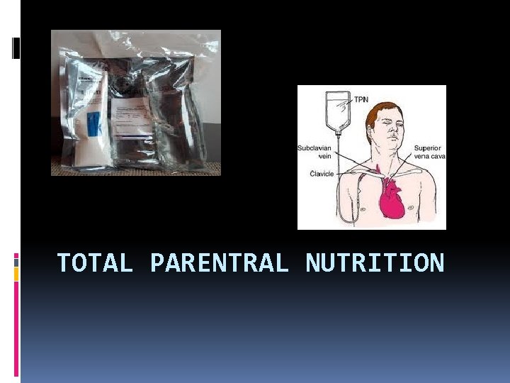 TOTAL PARENTRAL NUTRITION 